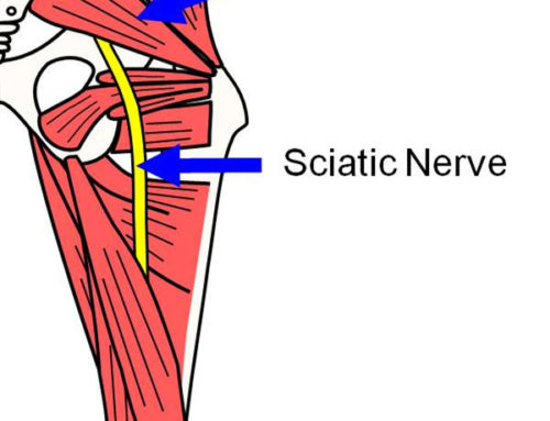 Sciatica or Piriformis Syndrome Treatment with Myofascial Release